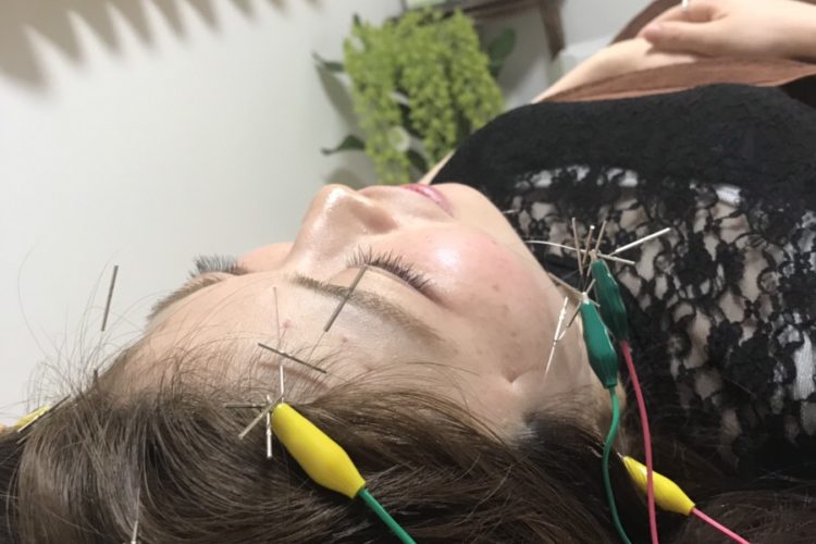 美容鍼の初体験レポート！超痛みに弱い私が美容鍼紹介ブログ書きます。